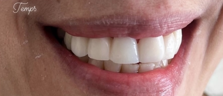 Dental Implants in Hackensack, NJ | Aesthetic Dental Center