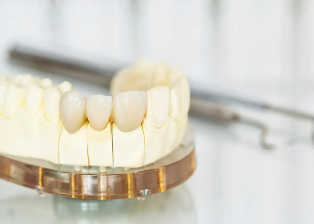 Close-up of a dental model displaying a set of upper teeth, focusing on a few front teeth, with dental tools blurred in the background. The setting appears clinical and professional.
