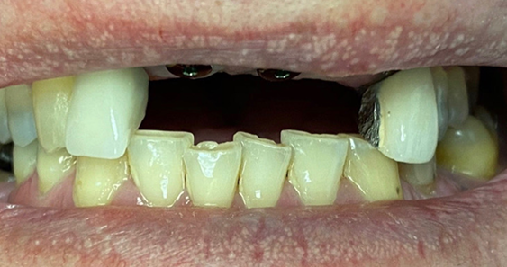 Close-up of a person's mouth showing top front teeth missing, bottom teeth yellowed and uneven, with visible gaps. Conveys dental issues or neglect.