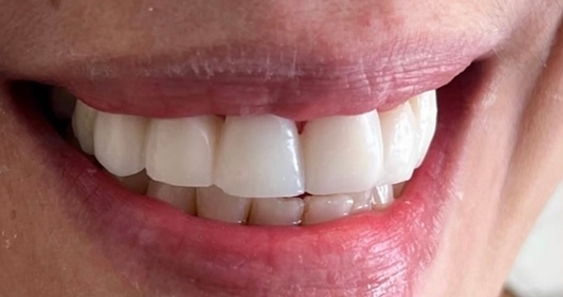 A close-up of a person smiling, showing clean, straight white teeth. The lips are slightly parted, revealing a natural, warm expression.