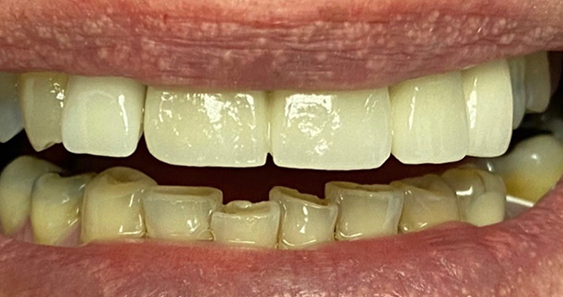 A close-up of a person smiling, showing clean, straight white teeth. The lips are slightly parted, revealing a natural, warm expression.