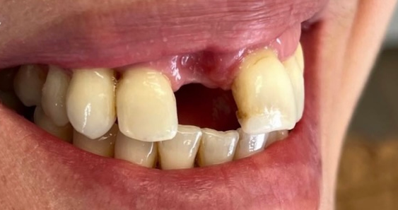 Close-up of a person's mouth with a missing upper front tooth. Surrounding teeth appear healthy. The image suggests a dental issue or gap.