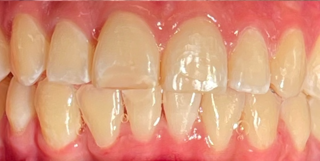 A close-up of a person smiling, showing clean, straight white teeth. The lips are slightly parted, revealing a natural, warm expression.