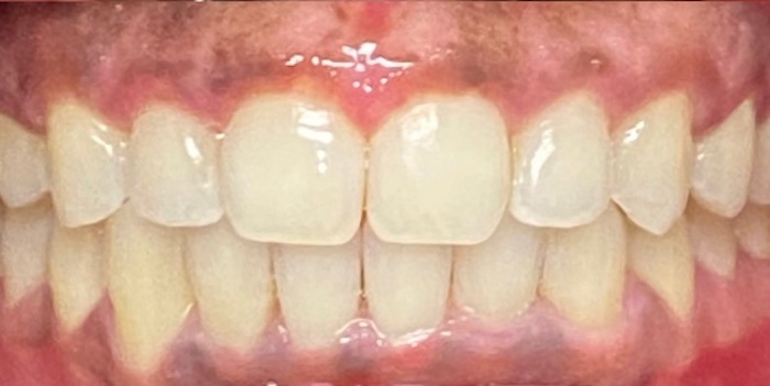 A close-up of a person smiling, showing clean, straight white teeth. The lips are slightly parted, revealing a natural, warm expression.