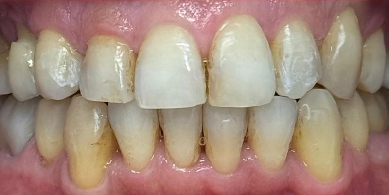 A close-up of a person smiling, showing clean, straight white teeth. The lips are slightly parted, revealing a natural, warm expression.
